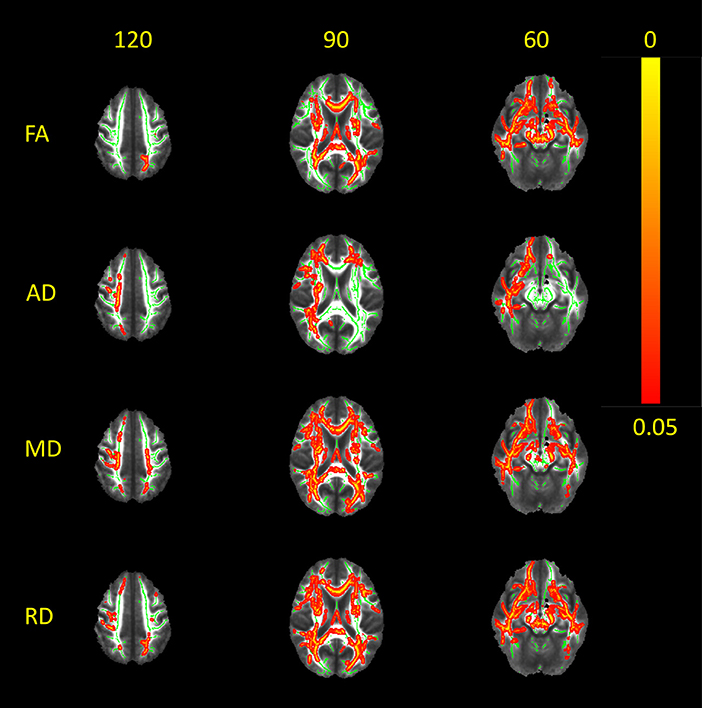 Distinctive Patterns of Seizure-Related White Matter Alterations in Right and Left Temporal Lobe Epilepsy